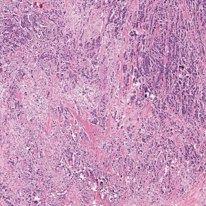 Stratipath Histological slide image_NHG2